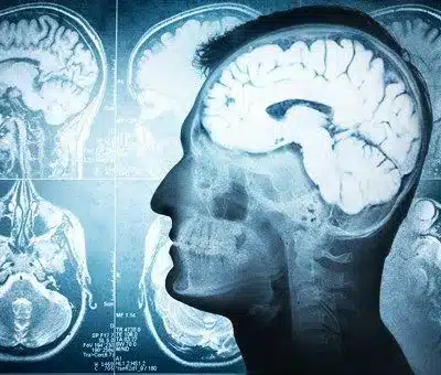 Brain injury case
